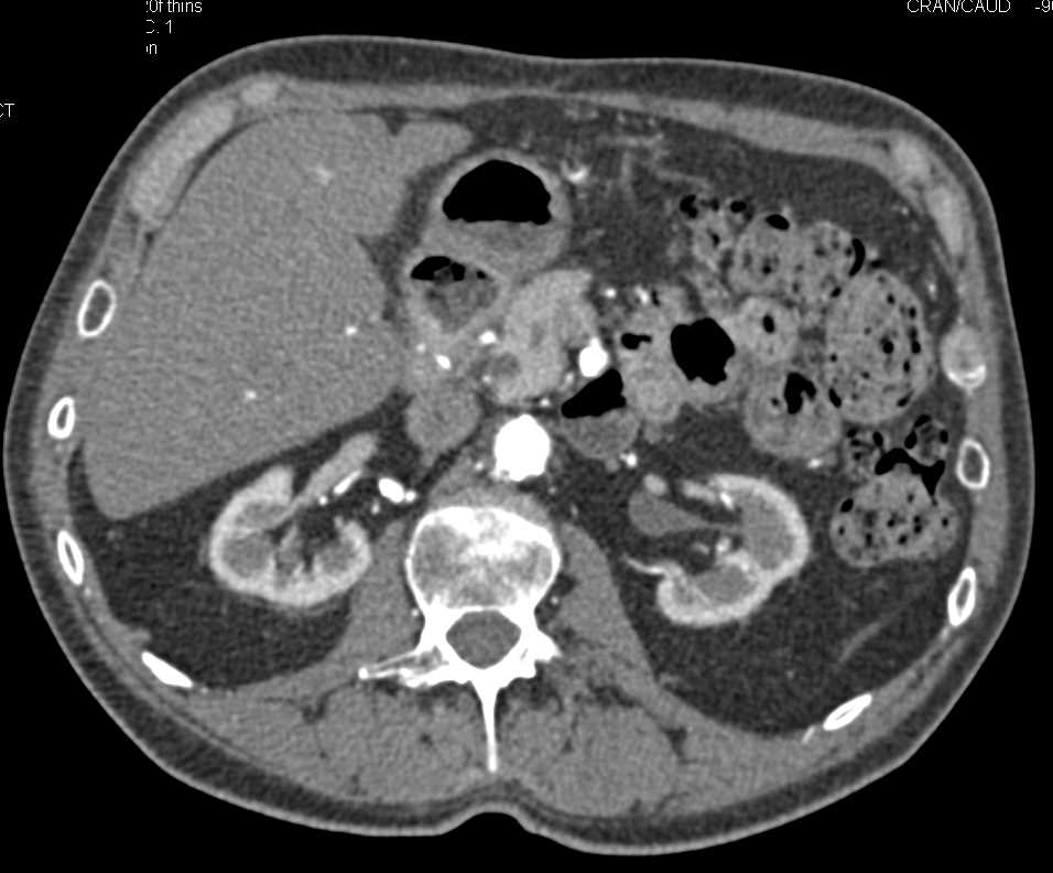 Non-opaque Stone in the Distal Common Bile Duct - CTisus CT Scan