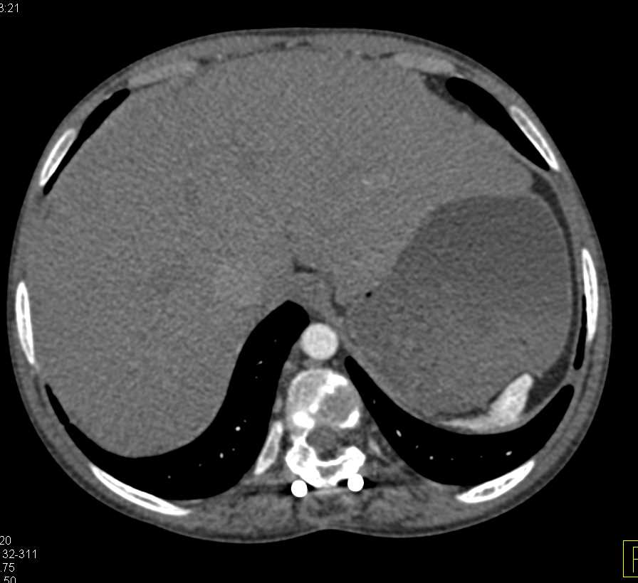 Sickle Cell Disease with Calcified Spleen and Scarring of the Kidneys - CTisus CT Scan