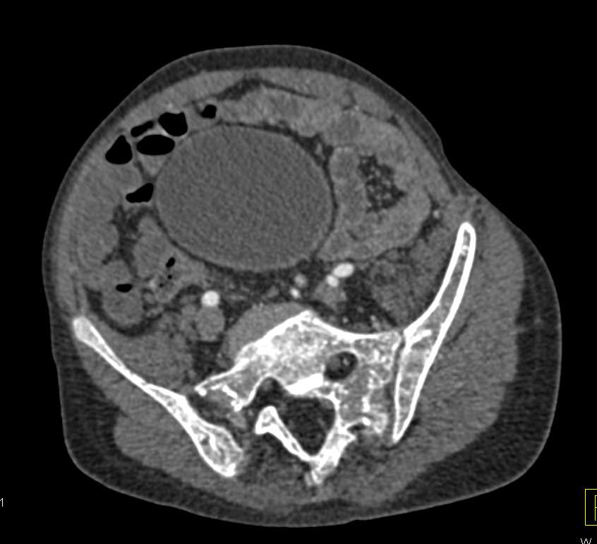 Sickle Cell Disease with Calcified Spleen and Scarring of the Kidneys and Papillary Necrosis - CTisus CT Scan