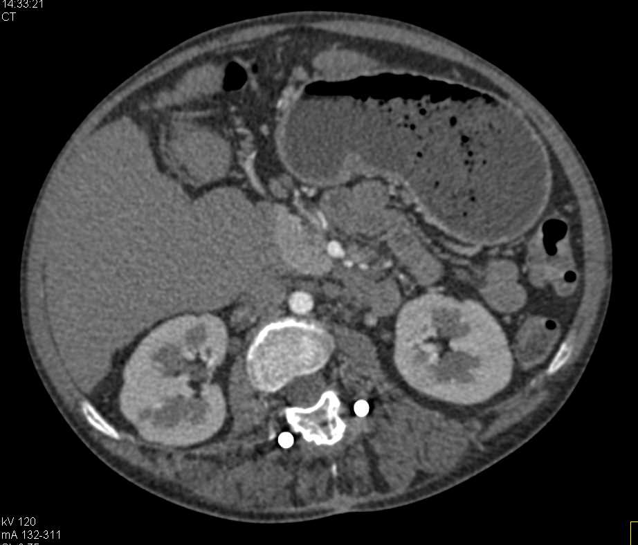 Sickle Cell Disease with Scarring of the Kidneys and Papillary Necrosis - CTisus CT Scan