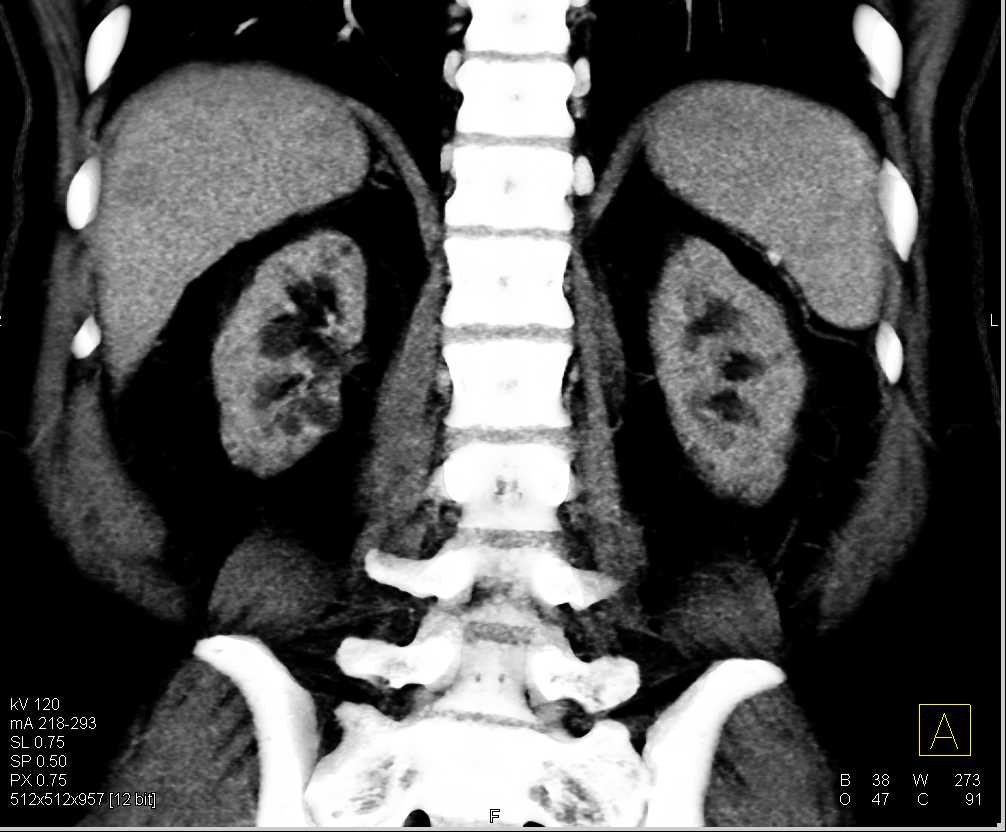 End Stage Renal Disease - CTisus CT Scan