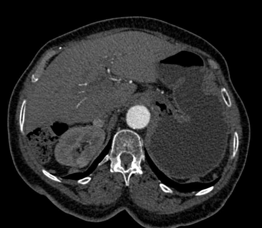 Left Nephrectomy for Renal Cell Carcinoma Without Recurrence - CTisus CT Scan