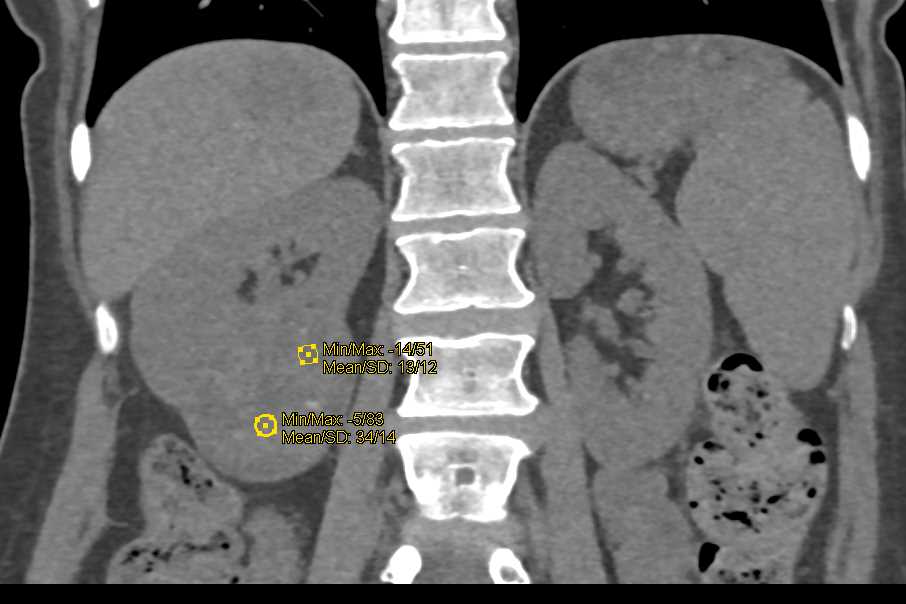 Papillary Renal Cell Carcinoma Right Kidney - CTisus CT Scan
