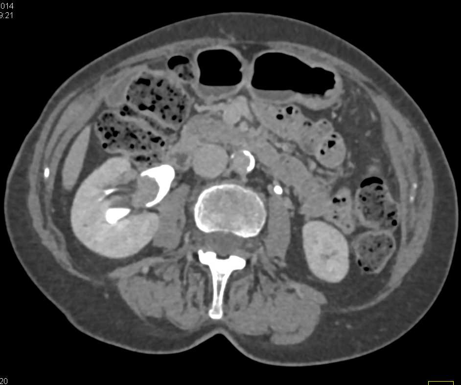 Transitional Cell Cancer (TCC) Right Renal Pelvis Kidney