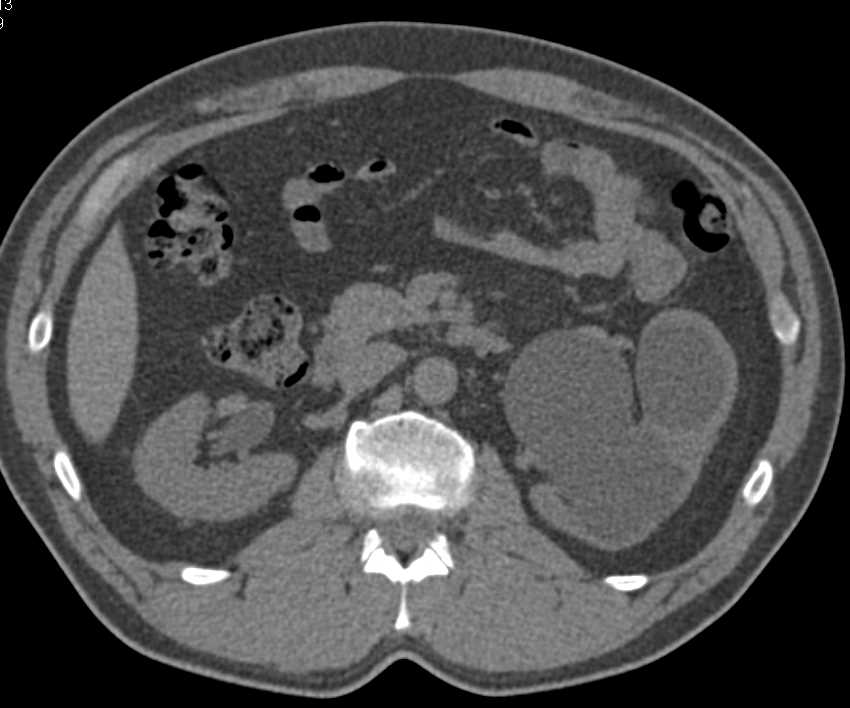 Left Ureteropelvic Junction (UPJ) Obstruction with Hydronephrosis - CTisus CT Scan