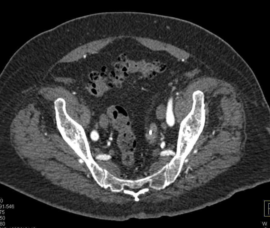 Partial Duplication of the Left Collecting System - CTisus CT Scan