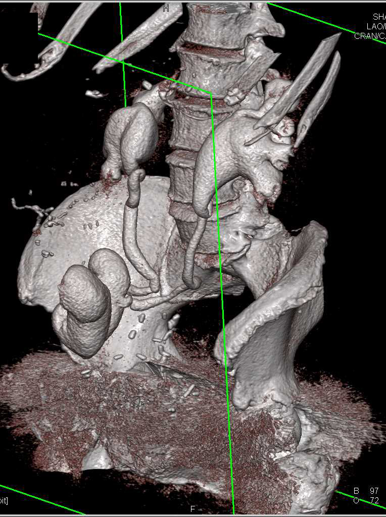 Hydronephrosis and Dilated Ureters to an Ileal Loop - CTisus CT Scan