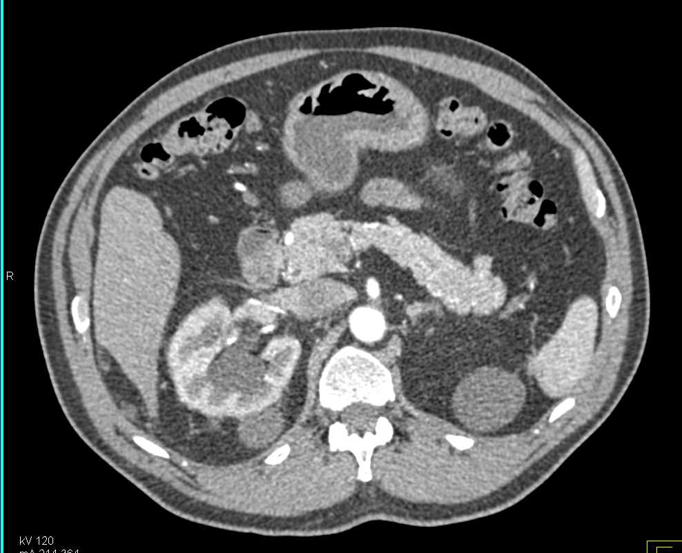 Pseudo aneurysm Near Partial Nephrectomy Site with Bleed - CTisus CT Scan