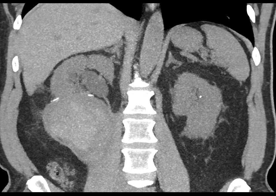 Pseudo aneurysm Near Partial Nephrectomy Site with Bleed - CTisus CT Scan