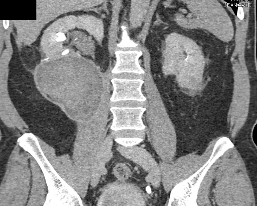 Pseudo aneurysm Near Partial Nephrectomy Site with Bleed - CTisus CT Scan