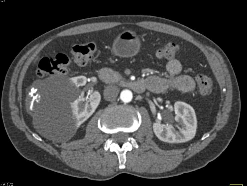 Complex Bosniak 2F Cyst - CTisus CT Scan