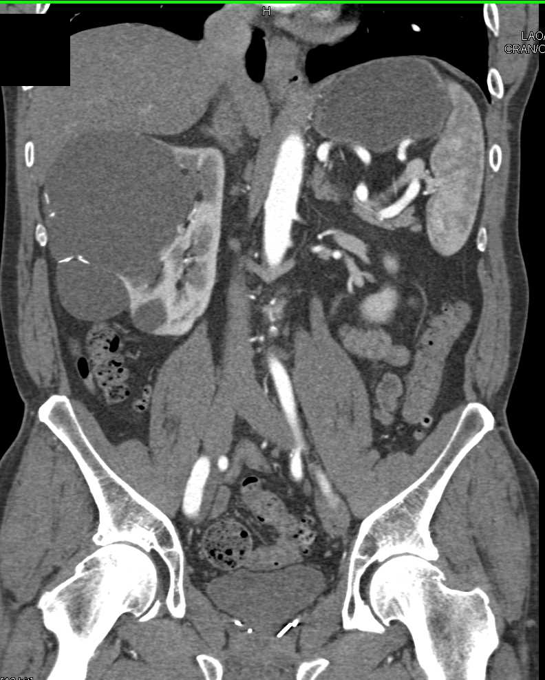 Complex Bosniak 2F Cyst - CTisus CT Scan