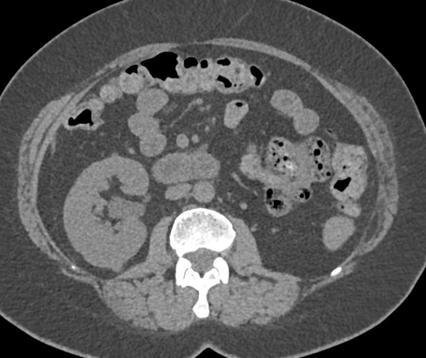 Multiple Metastases to the Right Kidney from a Left Renal Cell Carcinoma - CTisus CT Scan