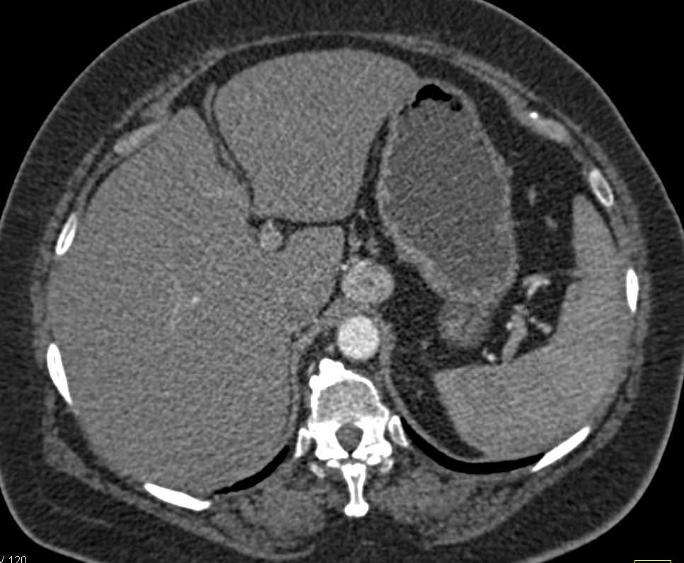 Recurrent Renal Cell Carcinoma with Contralateral Metastases and Vascular Adenopathy - CTisus CT Scan