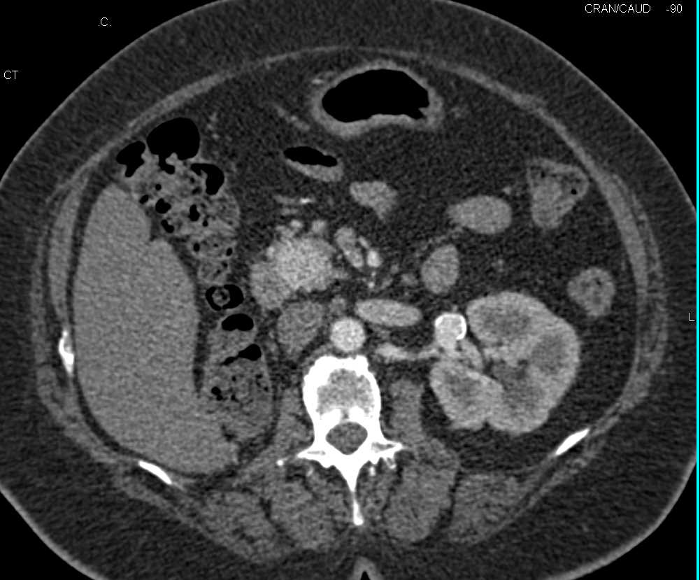 Recurrent Renal Cell Carcinoma with Contralateral Metastases, Pancreatic Metastases and Vascular Adenopathy - CTisus CT Scan