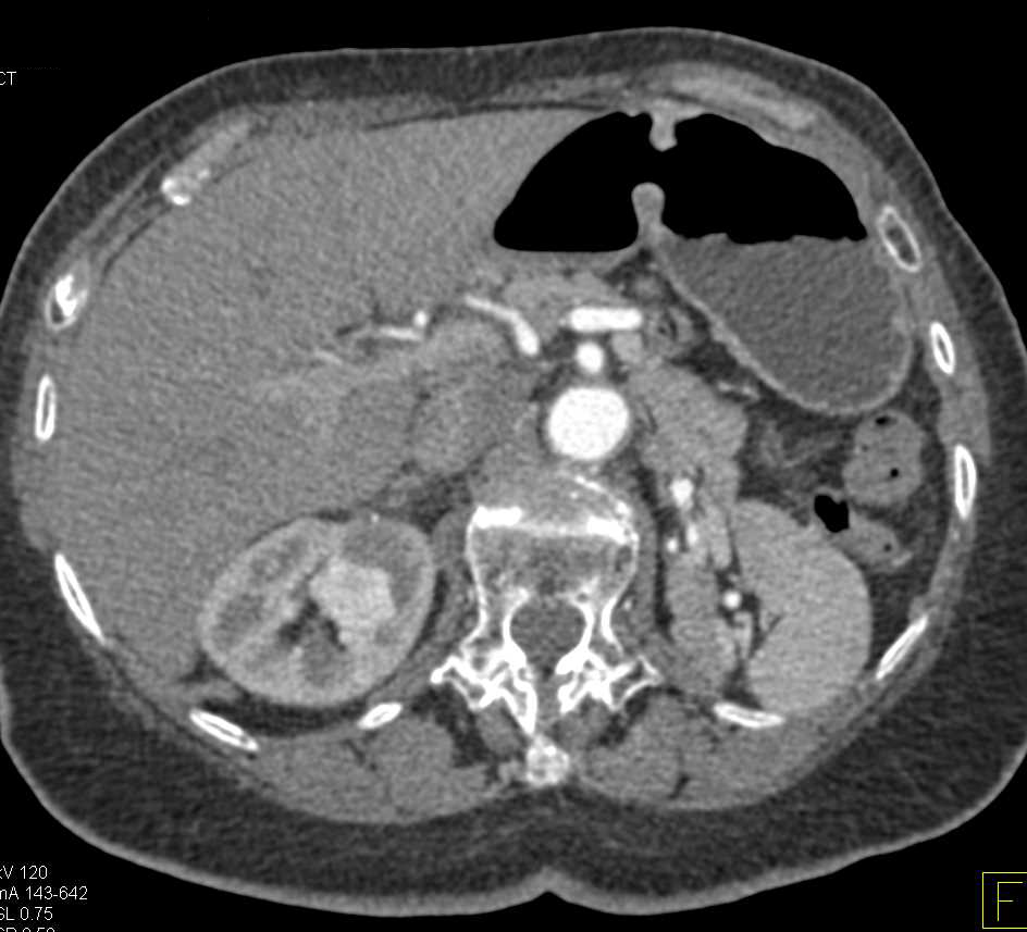 Left Renal Cell Carcinoma Metastatic to Contralateral Kidney - CTisus CT Scan