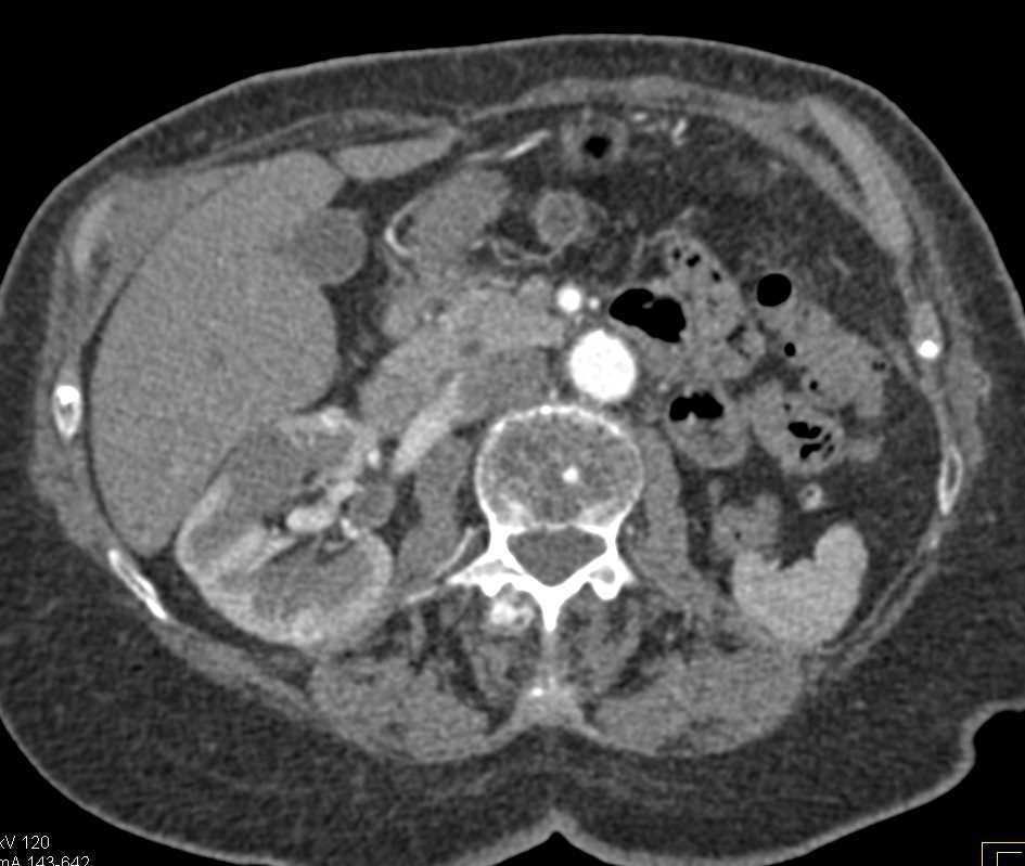 Left Renal Cell Carcinoma Metastatic to Contralateral Kidney - CTisus CT Scan