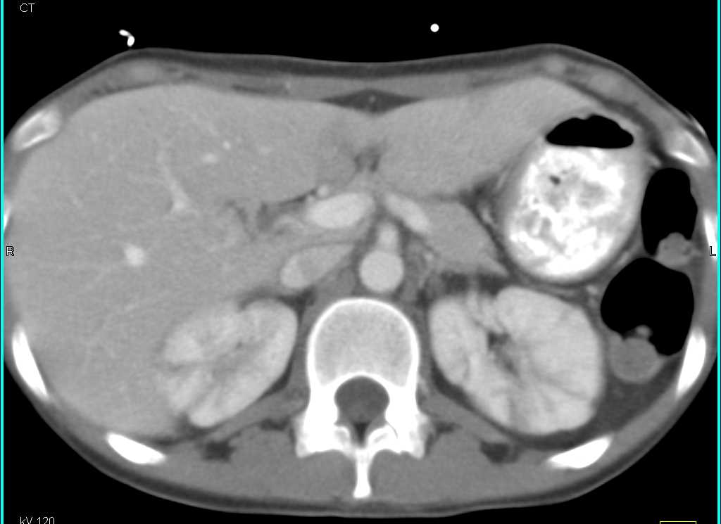 Striated Nephrograms and Acute Pyelonephritis - CTisus CT Scan