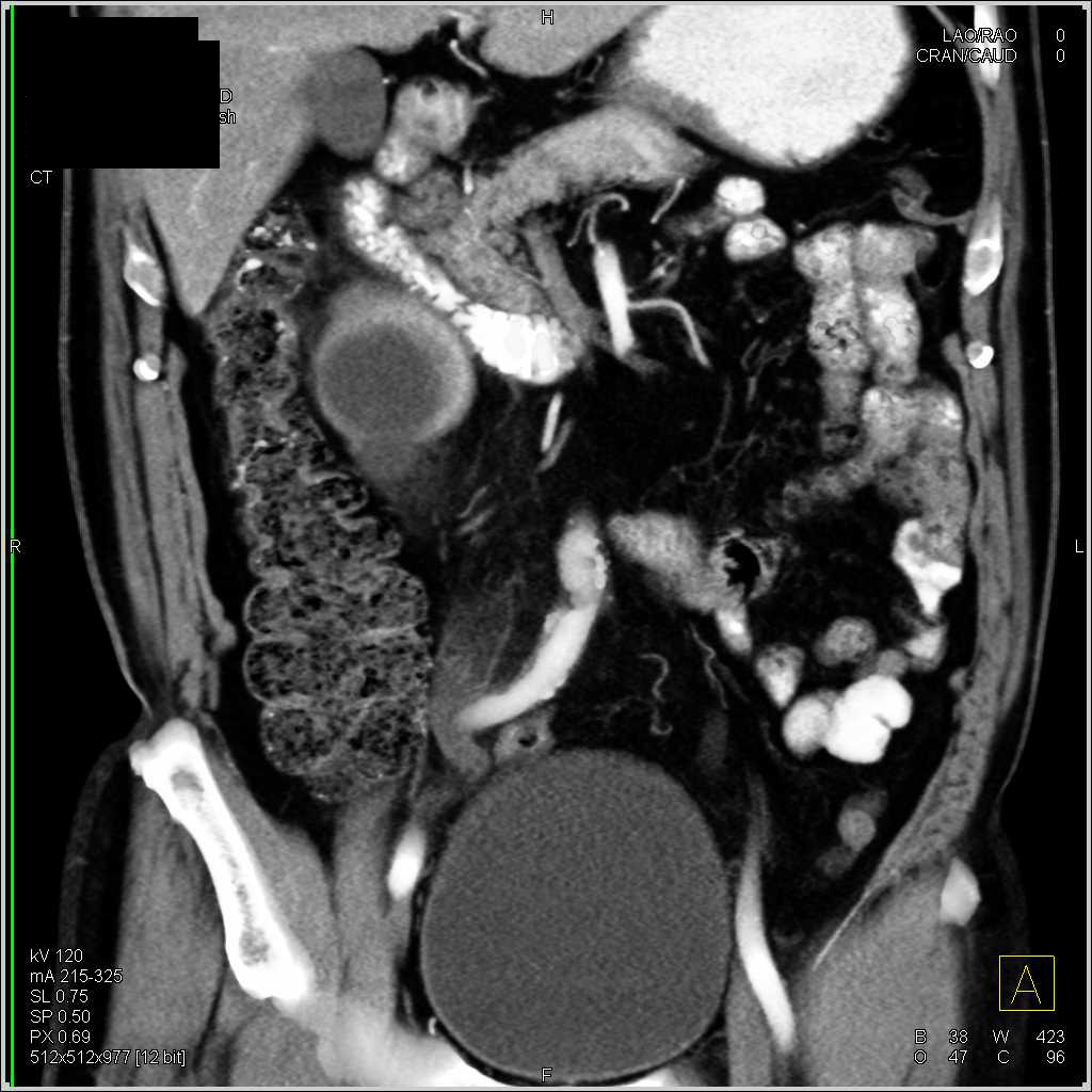 Obstructed Right Ureter by Tumor in the Distal Ureter - CTisus CT Scan