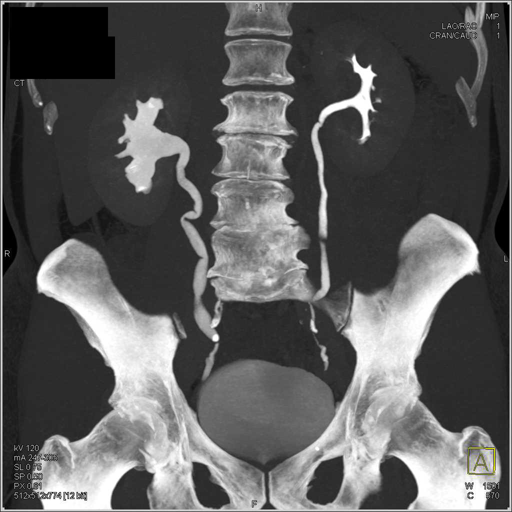 Right Hydronephrosis due to a Stone in the Distal Right Ureter - Kidney