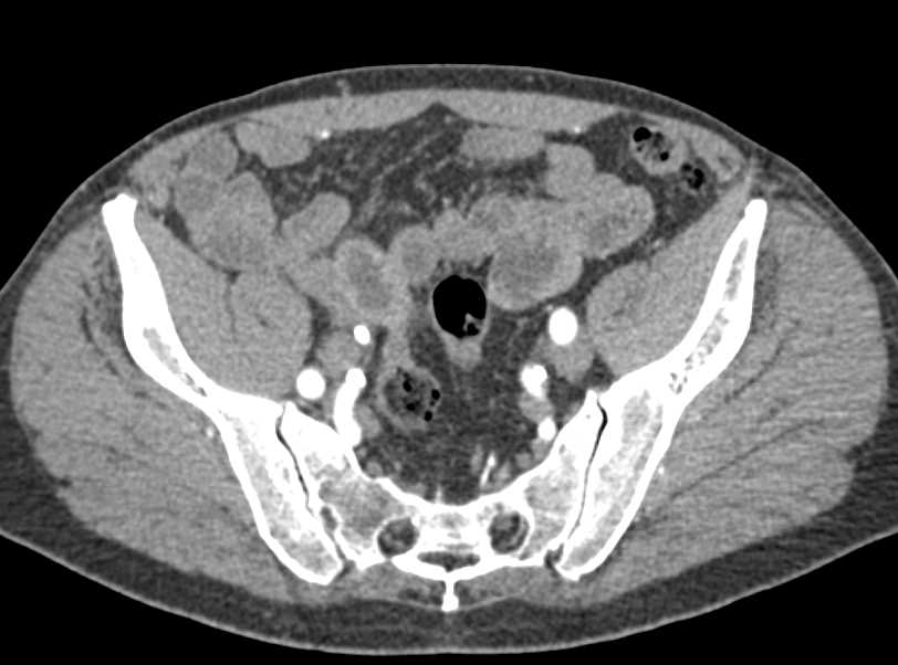 Right Hydronephrosis due to a Stone in the Distal Right Ureter - CTisus CT Scan