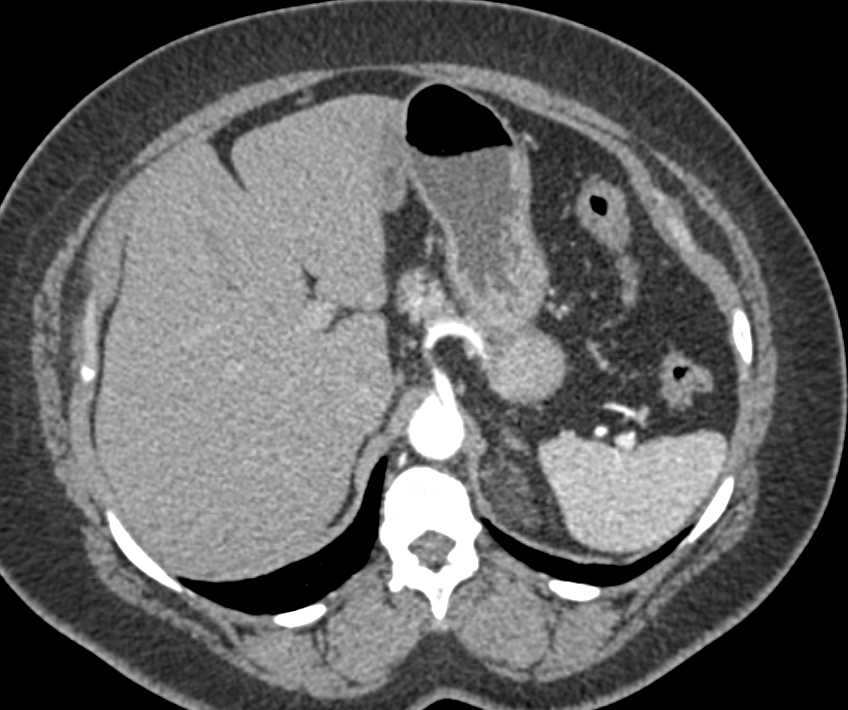 Left Renal Angiomyolipoma Upper Pole Left Kidney - CTisus CT Scan