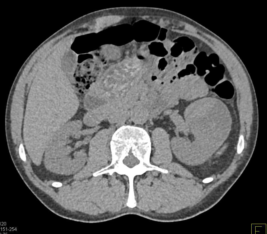 Cystic Left Renal Cell Carcinoma - CTisus CT Scan