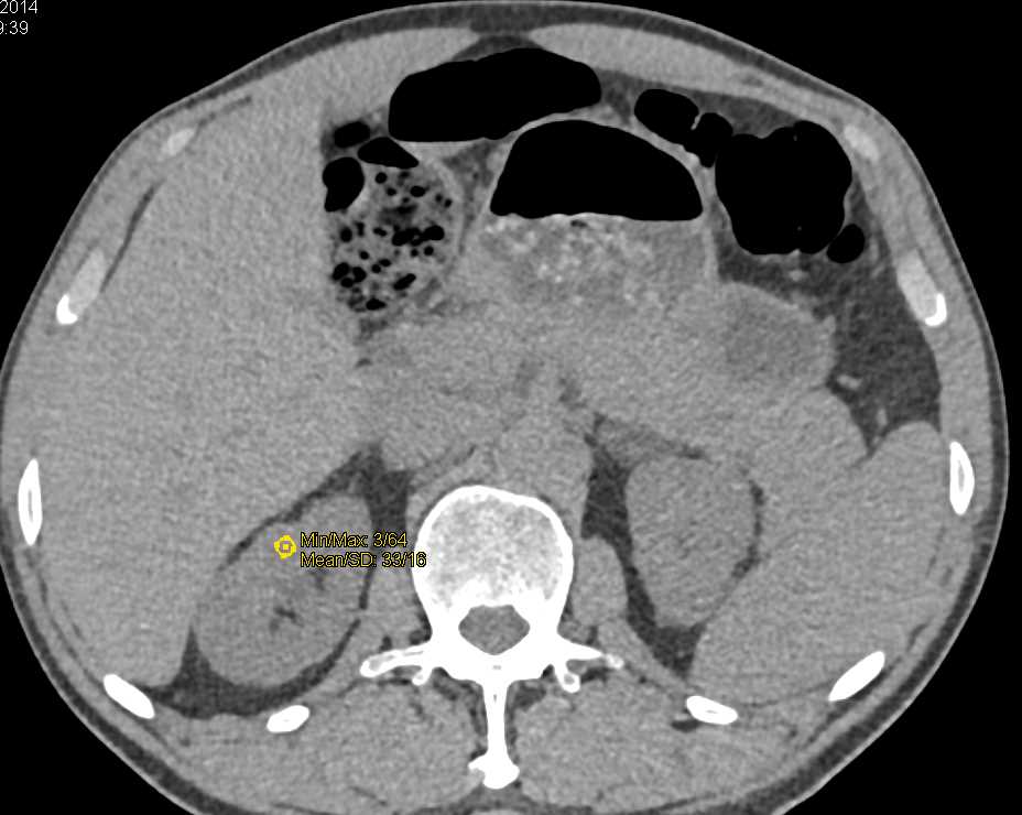 Cystic Left Renal Cell Carcinoma - CTisus CT Scan