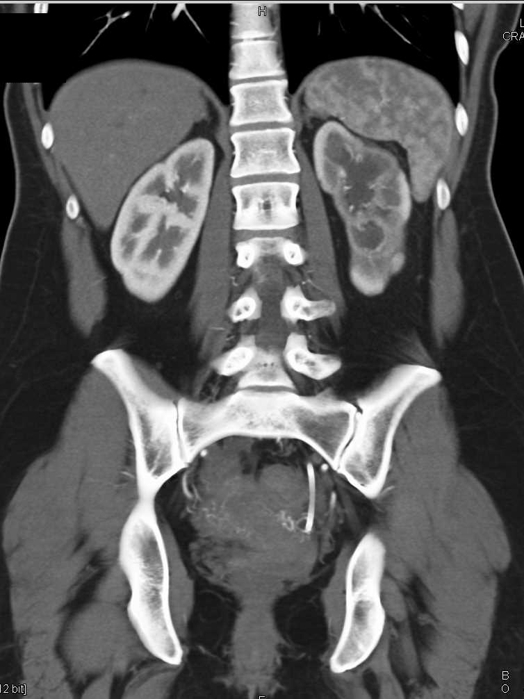 Obstructed Left Kidney with Decreased Function, Atrophy and Stent in Place - CTisus CT Scan