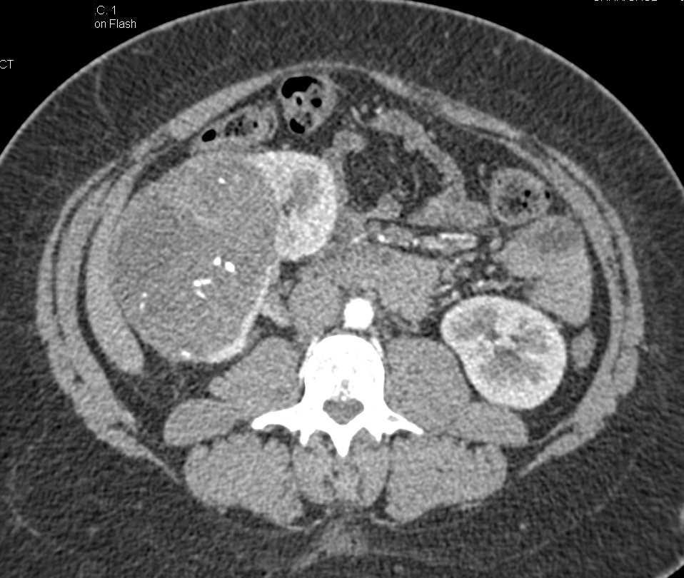 Atypical Clear Cell Renal Cell Carcinoma with Calcifications - CTisus CT Scan