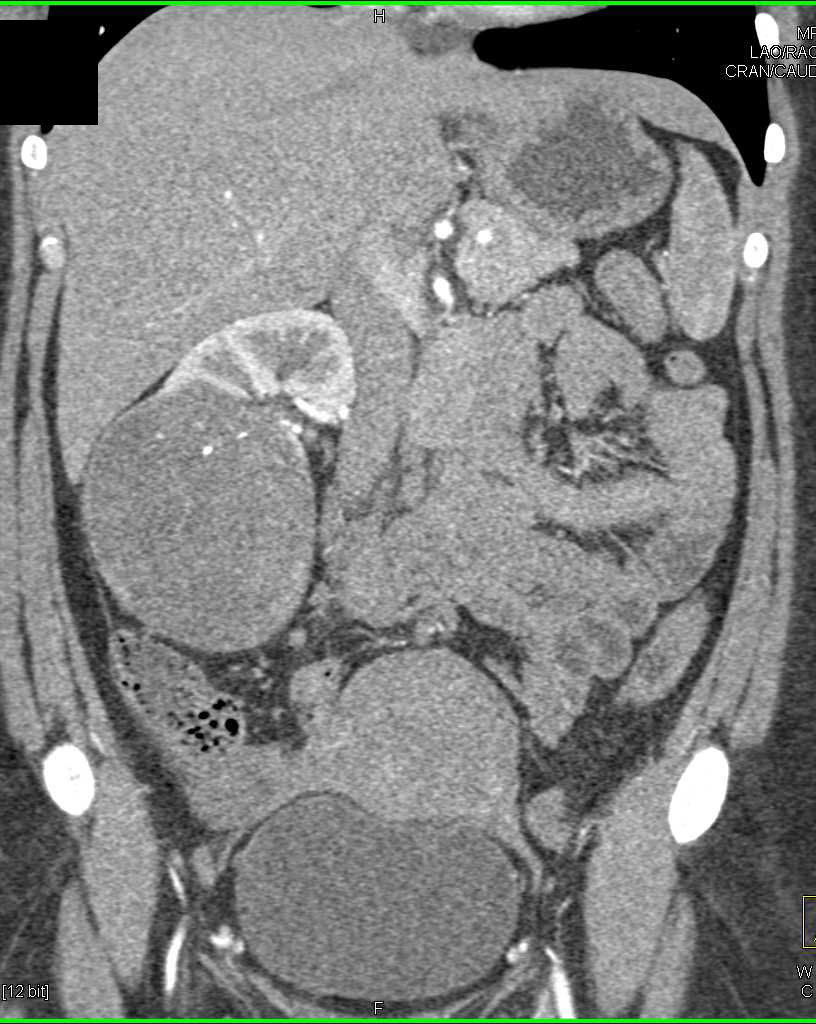 Clear Cell Renal Cell Carcinoma Right Kidney which is Hypovascular - CTisus CT Scan