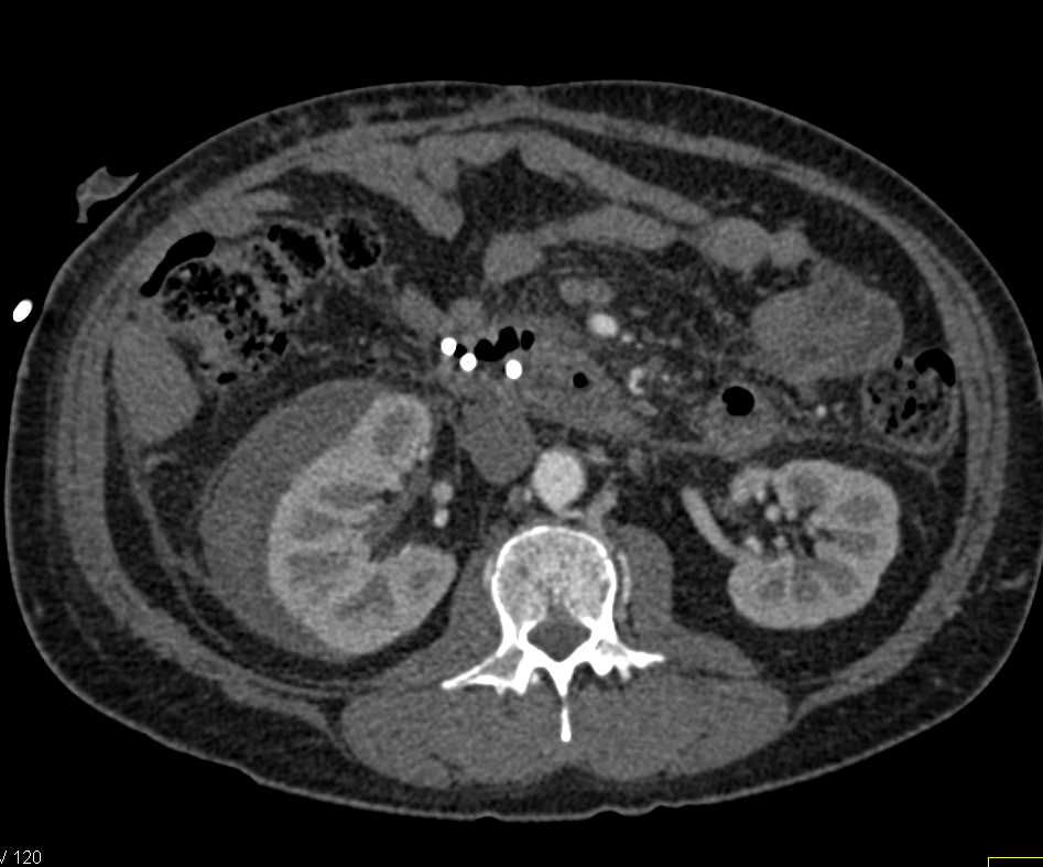 Perirenal Hematoma Right Kidney - Kidney Case Studies - CTisus CT Scanning