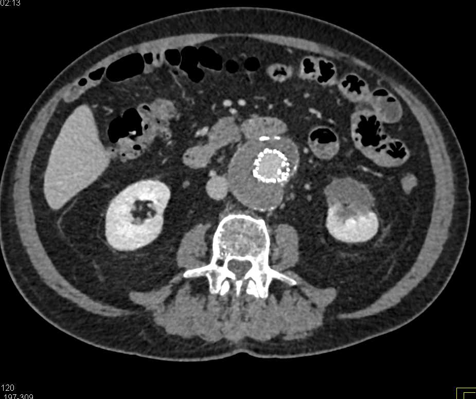 Infarct Left Kidney Following Endovascular Stent Repair - CTisus CT Scan