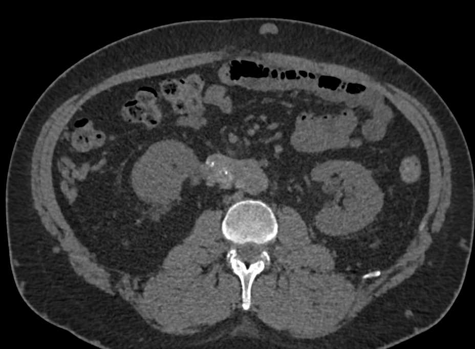 Retroperitoneal Fibrosis - CTisus CT Scan