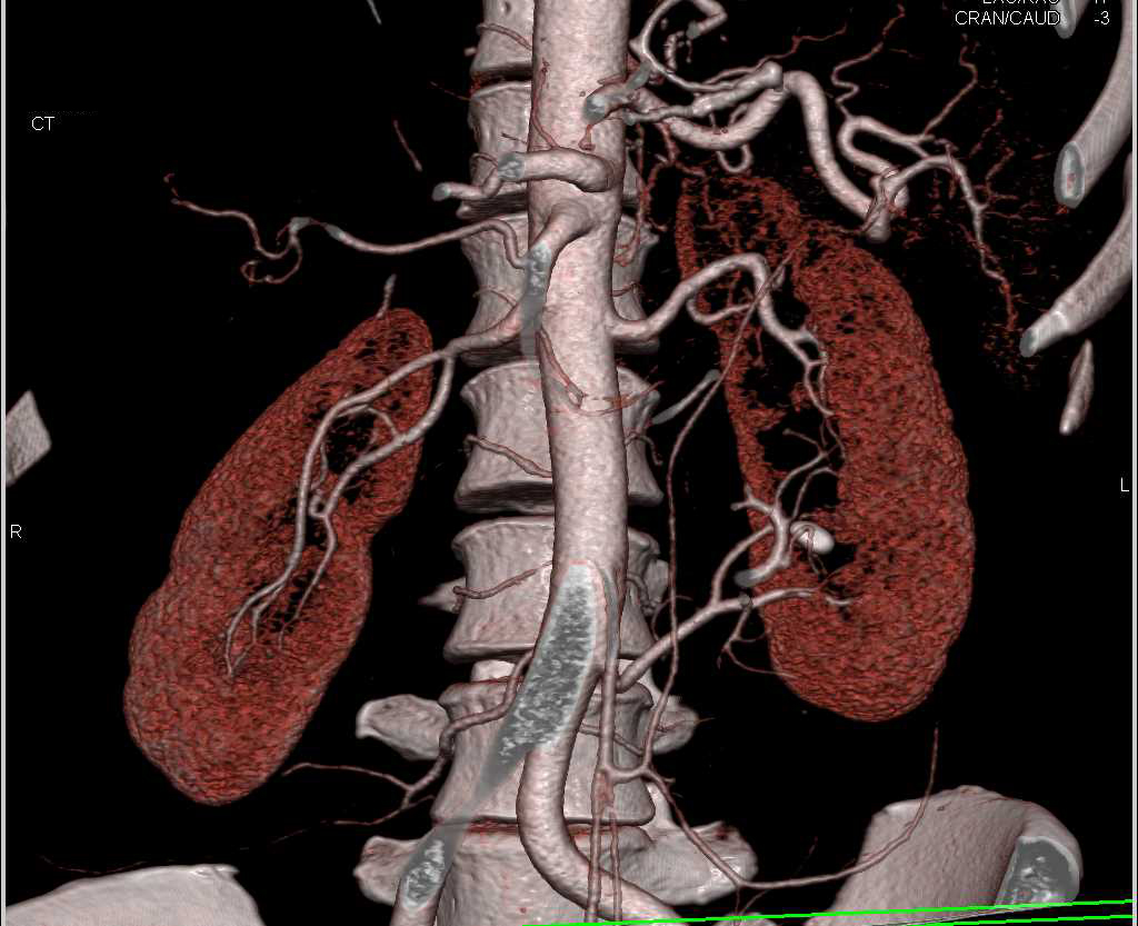 Retained Contrast in the Tubules Right Kidney Usually Means Renal ...