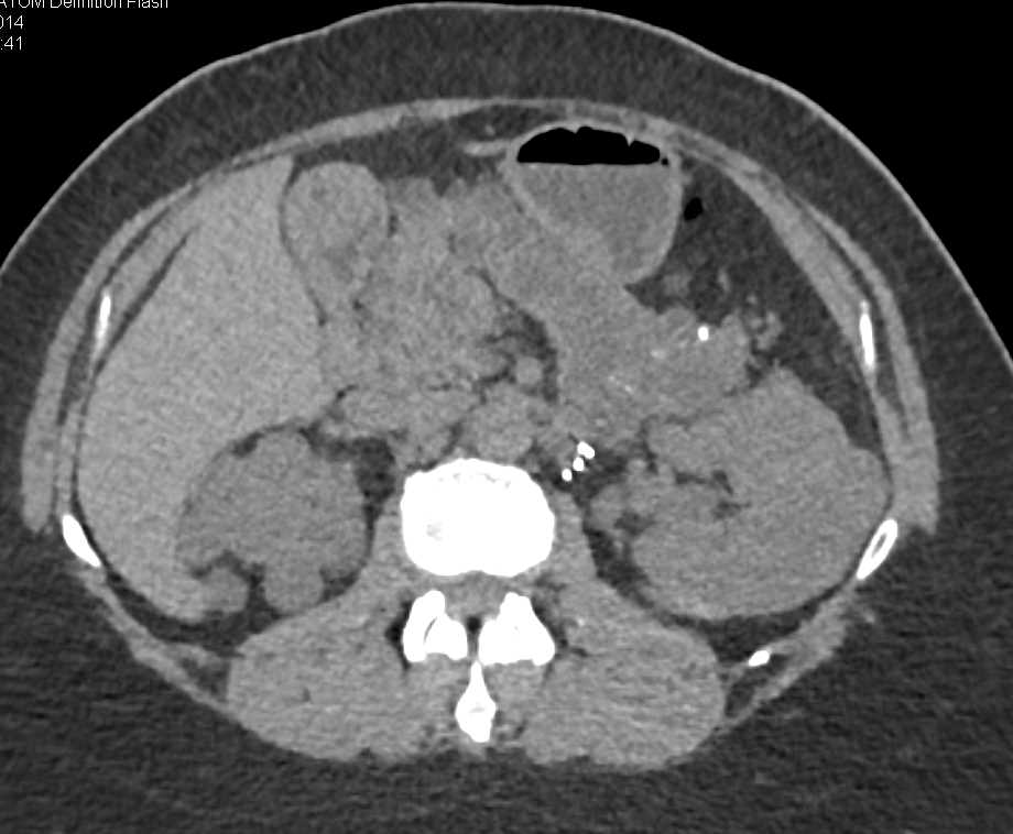 Von Hippel-Lindau syndrome (VHL) with Multiple Renal Carcinoma and Cysts as well as Pancreatic Cysts - CTisus CT Scan