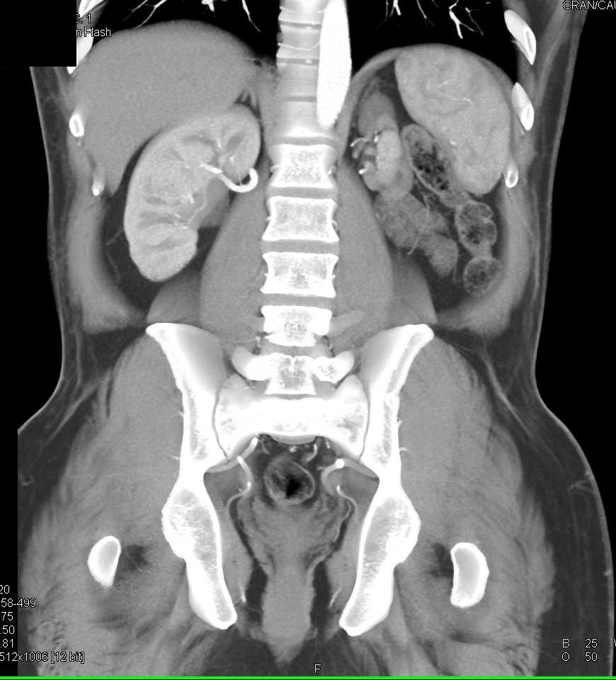 Atrophic Left Kidney Kidney Case Studies CTisus CT Scanning