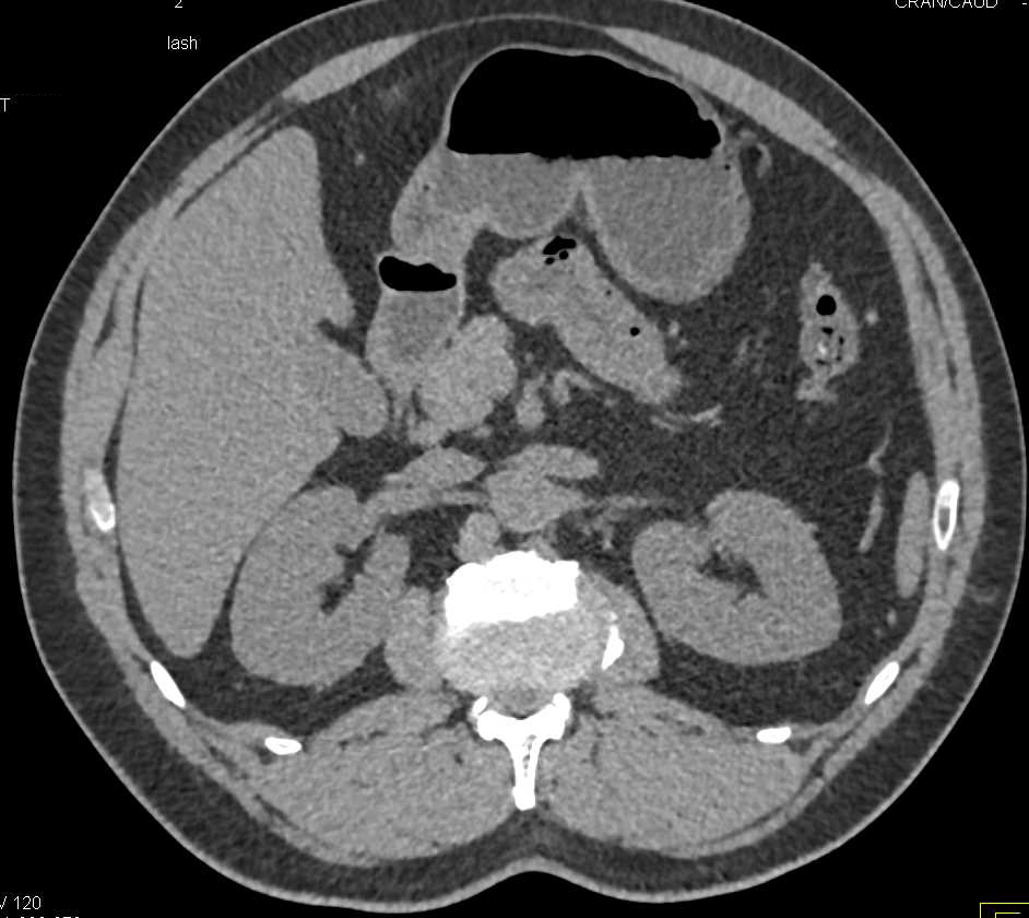 Subtle Pyelonephritis Upper Pole Right Kidney - CTisus CT Scan