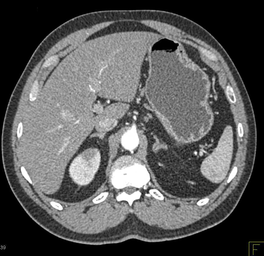 Subtle Pyelonephritis Upper Pole Right Kidney - CTisus CT Scan