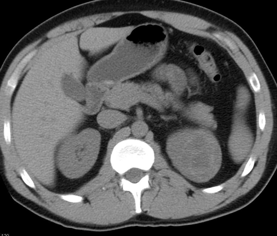 Cystic Renal Cell Carcinoma Left Kidney - CTisus CT Scan