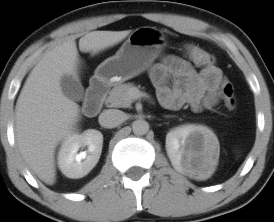 Cystic Renal Cell Carcinoma Left Kidney - CTisus CT Scan