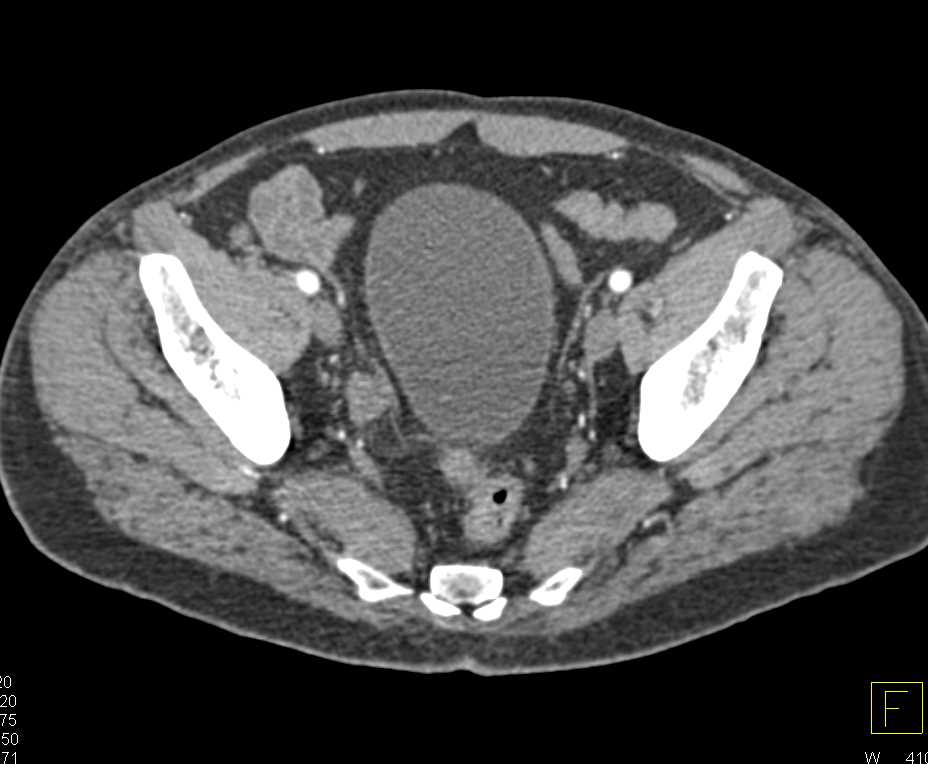 Carcinoma of Distal Right Ureter Obstructing the Right Kidney - CTisus CT Scan