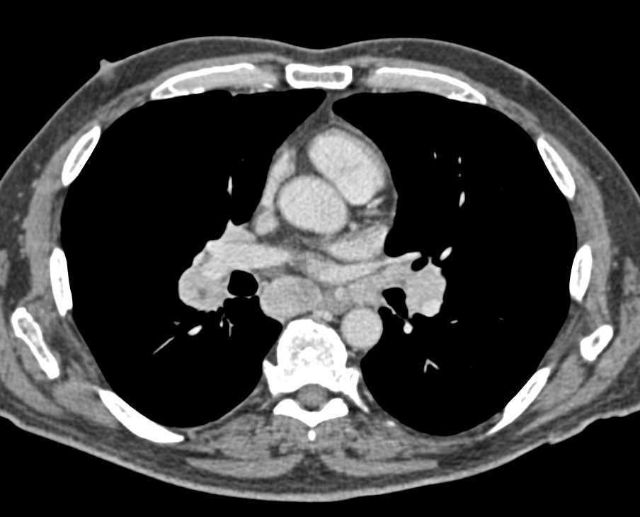 Recurrent Renal Cell Carcinoma with Extensive Adenopathy - CTisus CT Scan