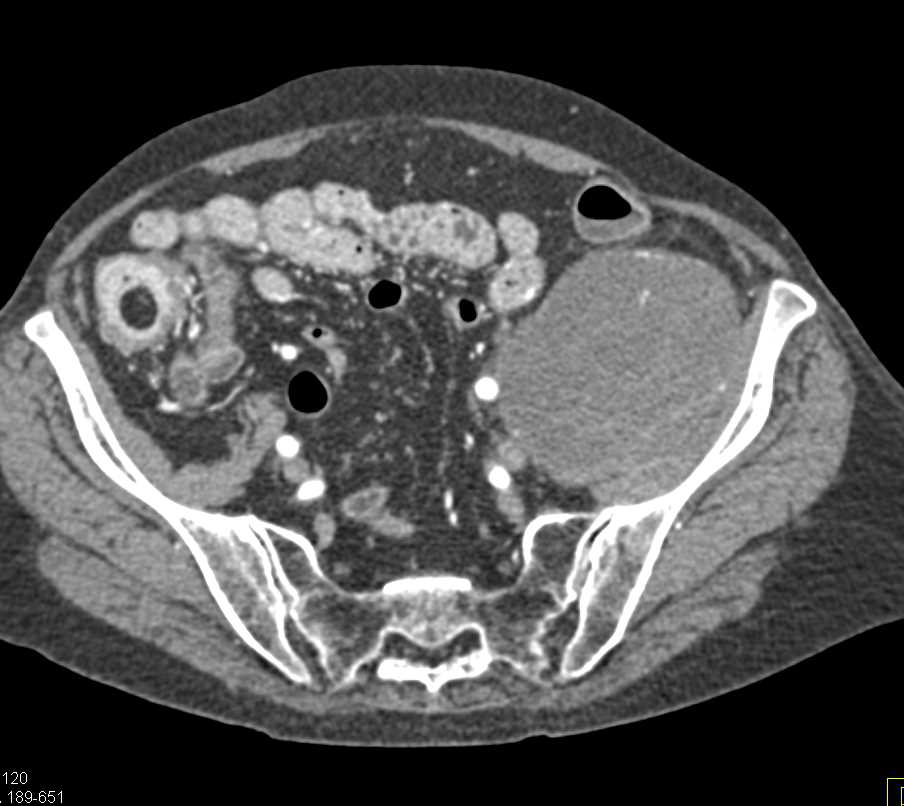 Neurogenic Sarcoma - CTisus CT Scan