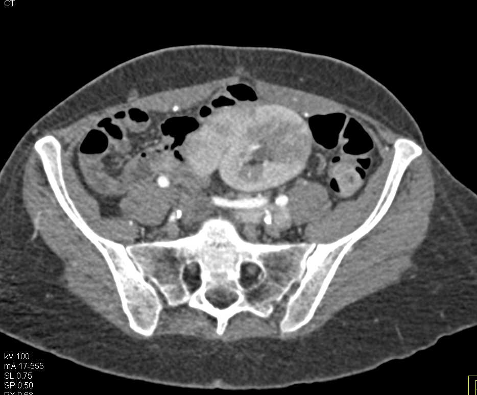 Acute Pyelonephritis in a Transplant Patients Transplant Kidney - CTisus CT Scan