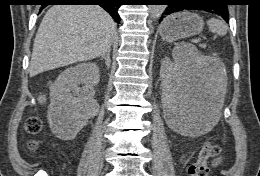 Cystic Renal Cell Carcinoma Left Kidney - CTisus CT Scan