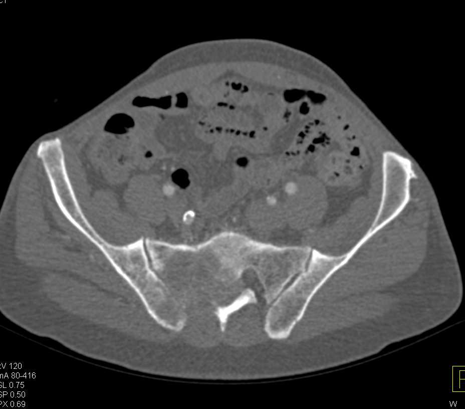 Metastatic Renal Cell Carcinoma to the Liver and Sacrum - CTisus CT Scan