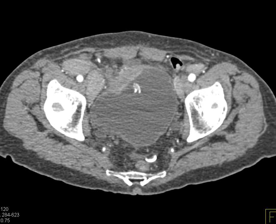 Bulky Bladder Cancer with Extensive Adenopathy and Right Hydronephrosis - CTisus CT Scan