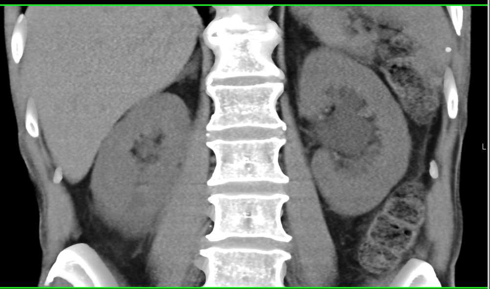 Bladder Cancer with Left Hydronephrosis - CTisus CT Scan