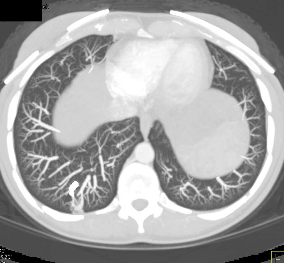 Bilateral Renal Angiomyolipomas in a Patient with Tuberous Sclerosis - CTisus CT Scan